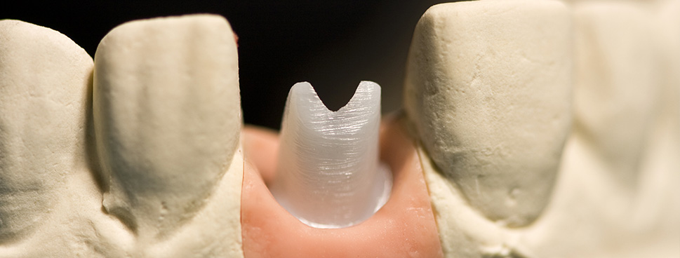 Zirconia-Abutment